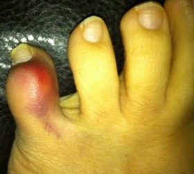 Stubbed toe